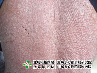 [濰坊銀屑病醫(yī)院東方研究院]牛皮癬的治療方法