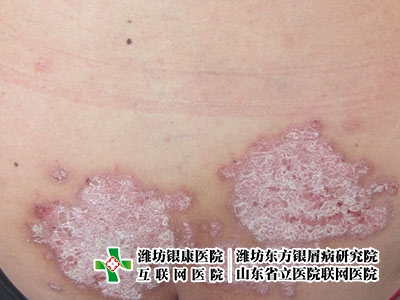 [濰坊皮膚病醫院東方研究院]牛皮癬早期的癥狀是什么?西醫牛皮癬治療方法有什么副作用