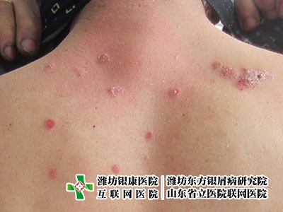 [濰坊銀屑病研究院]牛皮癬不能吃什么?