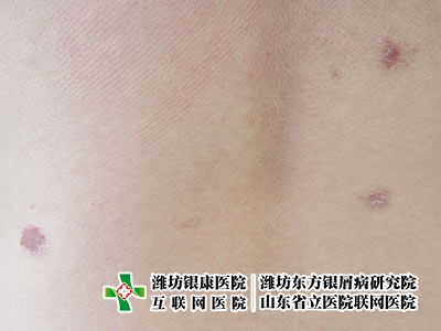 [東方銀屑病研究院附屬銀康醫(yī)院]牛皮癬用什么藥治療好
