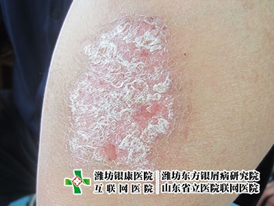 [濰坊牛皮癬醫院東方研究院]兒童銀屑病怎么護理呢?