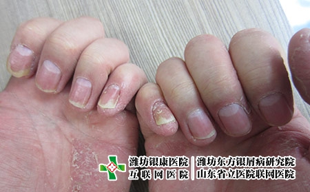 指甲牛皮膚癬病變后病甲要不要剪掉
