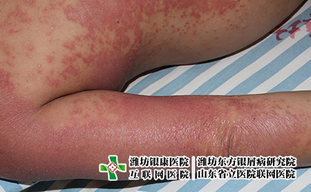 [濰坊那家銀屑病醫院有名氣]青少年銀屑病的病因有哪些