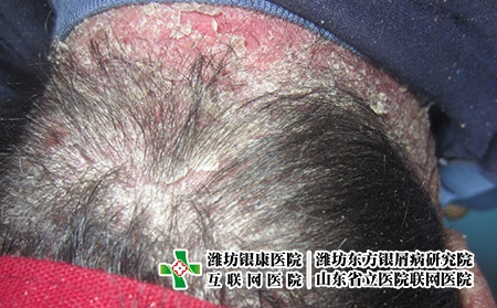 [濰坊銀屑病醫院排名]銀屑病的危害表現是什么?