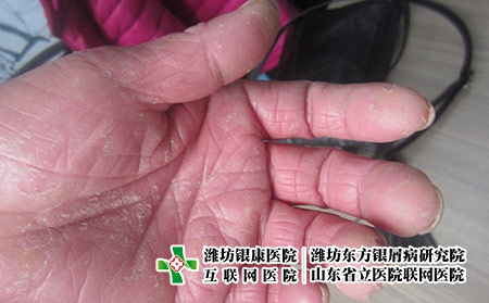 [濰坊銀屑病到底該怎樣治療]銀屑病怎么治療好