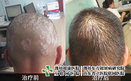 頭皮銀屑病對比圖 頭皮銀屑病對比圖
