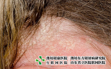 牛皮膚癬的癥狀對比圖片