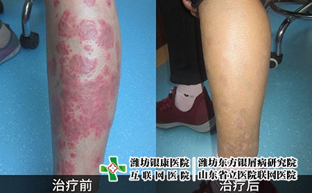 牛皮膚癬的對比圖片