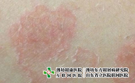 牛皮膚癬和玫瑰糠疹 牛皮膚癬和玫瑰糠疹