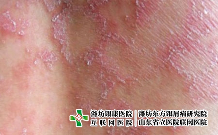 牛皮膚癬和玫瑰糠疹的區別有什么 牛皮膚癬和玫瑰糠疹的區別有什么