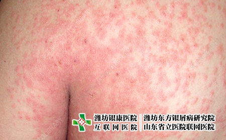 牛皮膚癬和玫瑰糠疹有什么樣子的不同 牛皮膚癬和玫瑰糠疹有什么樣子的不同