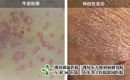 牛皮膚癬和神經(jīng)性皮炎圖片對比癥狀