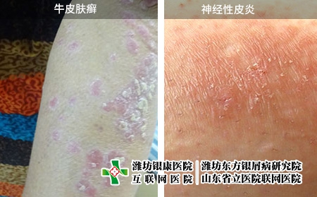 牛皮膚癬和神經(jīng)性皮炎癥狀圖片