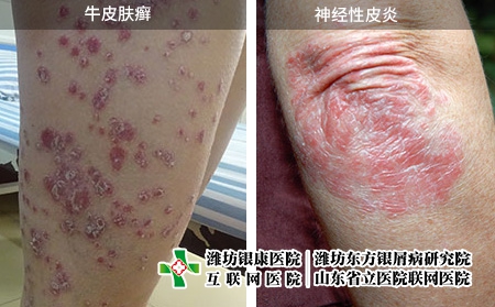 牛皮膚癬和神經(jīng)性皮炎圖片對比
