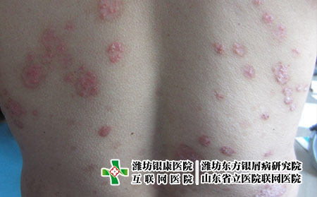 背部滴狀牛皮膚癬圖片