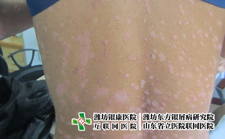 后背上的滴狀牛皮膚癬圖片