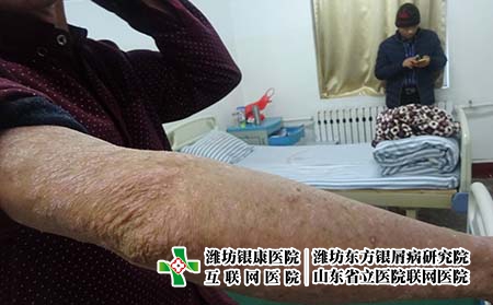 牛皮膚癬癥狀圖片