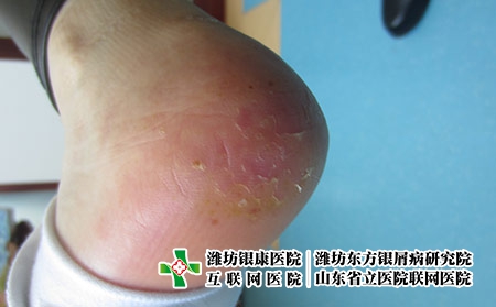 腳部牛皮膚癬癥狀圖片