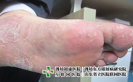 腳部牛皮膚癬圖片