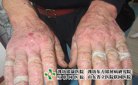 手背手關節掌跖膿皰銀屑病的癥狀圖片