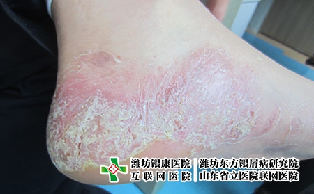 掌跖膿皰銀屑病腳部癥狀