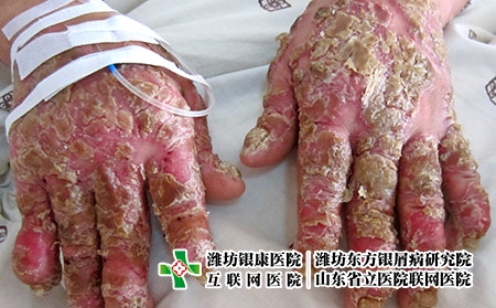 重型掌跖膿皰銀屑病圖片
