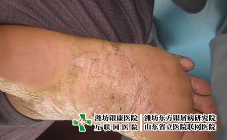掌跖膿皰牛皮癬病的腳底癥狀