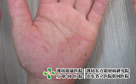 掌跖膿皰銀屑病癥狀圖片特征