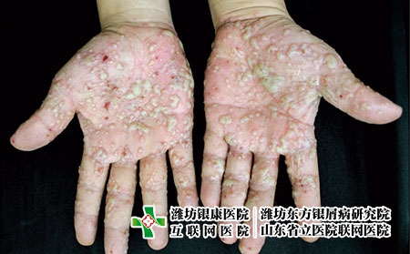 掌跖膿皰病癥狀圖片