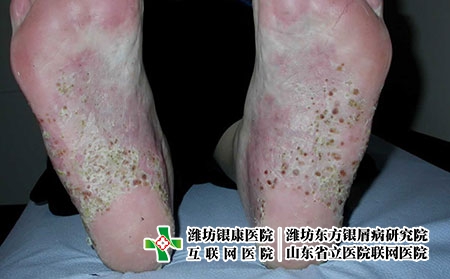 早期掌跖膿皰病臨床照片