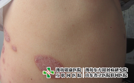 牛皮皮癬怎么造成的?濰坊牛皮皮癬醫院那家好