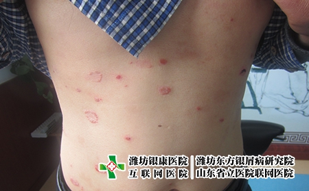 當下疫情必備6種藥，艾草洗牛皮癬作護理可以嗎