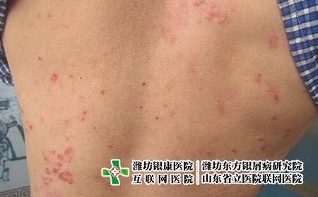 治新冠最有效三種藥物，如何才能制止牛皮癬的擴散