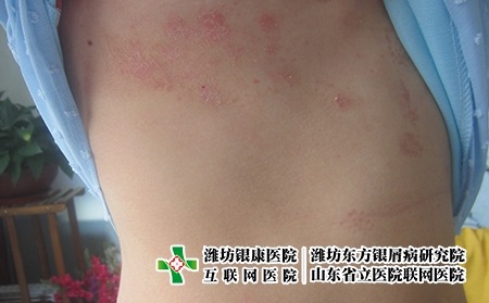 中國宣布取消新冠免費治療，男女牛皮癬的危害