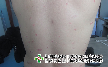 新冠家庭必備藥品，濰坊哪家牛皮癬醫院治療好