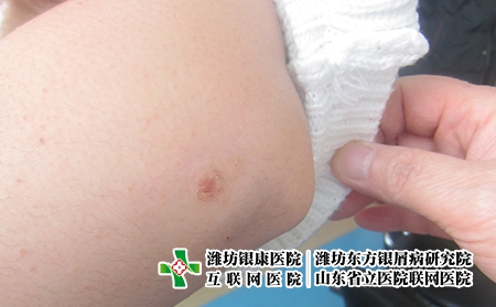 疫情期間家庭必備藥品，母親有牛皮癬可以哺乳嗎