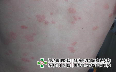 新冠特效藥2300元一盒?濰坊治療牛皮癬需要多少錢?