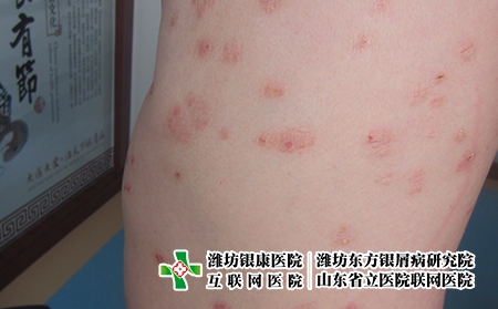 新冠期間10類禁售藥品?濰坊哪里看牛皮癬醫院好