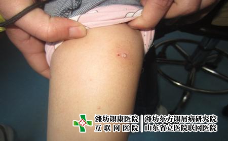 陽了我卻一點都不慌了?5個月寶寶得了牛皮癬怎么辦