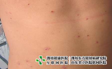 復陽患者多久轉陰?濰坊有牛皮癬怎么辦?