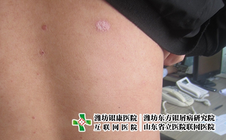 陽性是什么原因?濰坊牛皮癬怎么治比較好