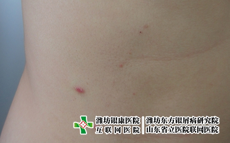 沒出結(jié)果是不是陽了?濰坊哪家醫(yī)院可以治療牛皮癬