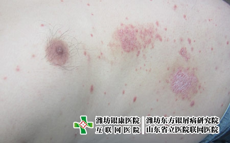 陽過的人復(fù)陽有傳染性嗎?濰坊牛皮癬治療醫(yī)院哪家好