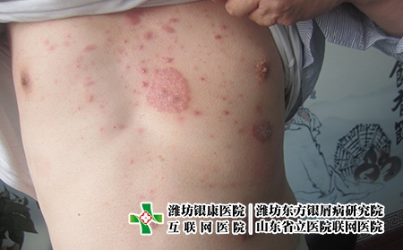 什么樣的人容易復陽?濰坊牛皮癬是怎么回事