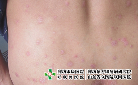 如果是陽性怎么辦?哪些因素可以幫助濰坊牛皮癬患者增強免疫力呢