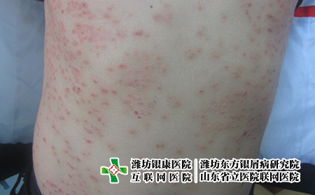 陽性治好了會復(fù)發(fā)嗎?濰坊牛皮癬飲食要注意什么