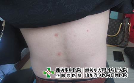 陽性怎么轉陰?濰坊女性牛皮癬診斷方法