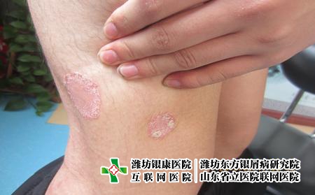 濰坊兒童牛皮癬應該怎樣預防?濰坊治銀屑病皆推東方