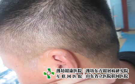 牛皮癬的的治與防該怎么做?濰坊哪個醫院看牛皮癬專業