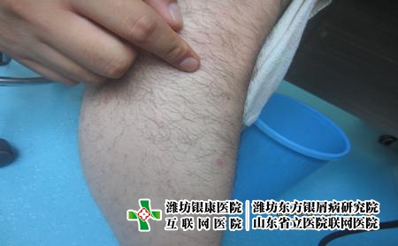 面部治療牛皮癬的方法?濰坊牛皮癬皮膚醫院